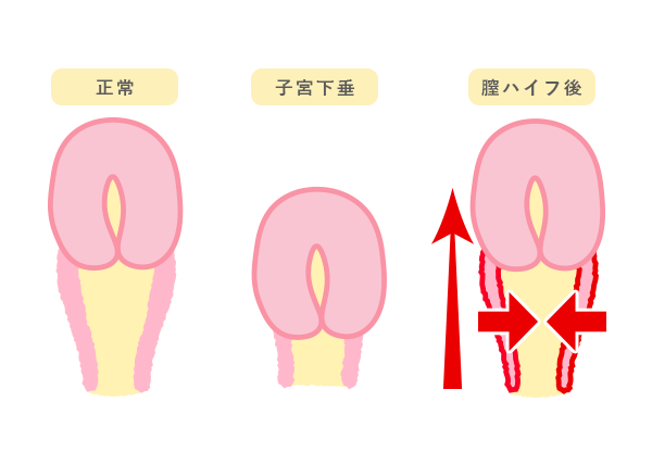 膣ハイフの図