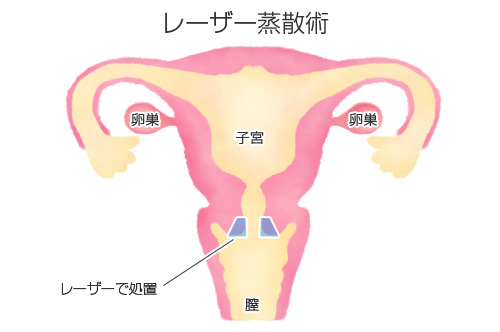 レーザー蒸散術の図