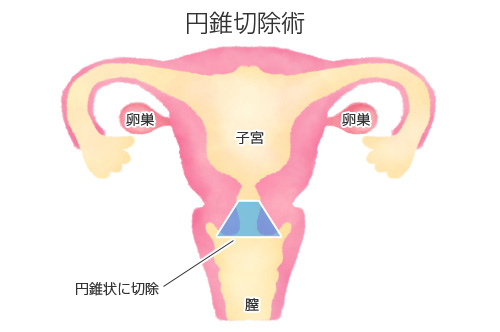 子宮頚部円錐切除術の図